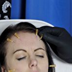 Second pic of Needle Tortured Patient