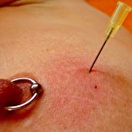 Third pic of Saline Injection