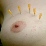 Fourth pic of Outdoor Needle Pain