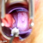 Fourth pic of Mature Olga has her redhead hairy pussy gyno speculum examined by gyno doctor