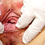 Third pic of Romana  elder minge gyn tool gyno observation at clinic